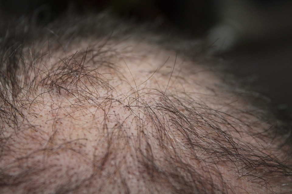 Caduta dei capelli: le cause e le soluzioni